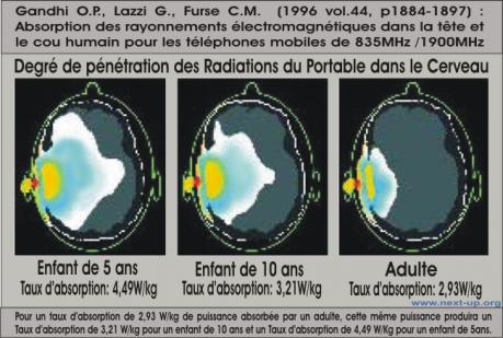 imagerie irradiation cerveau portable